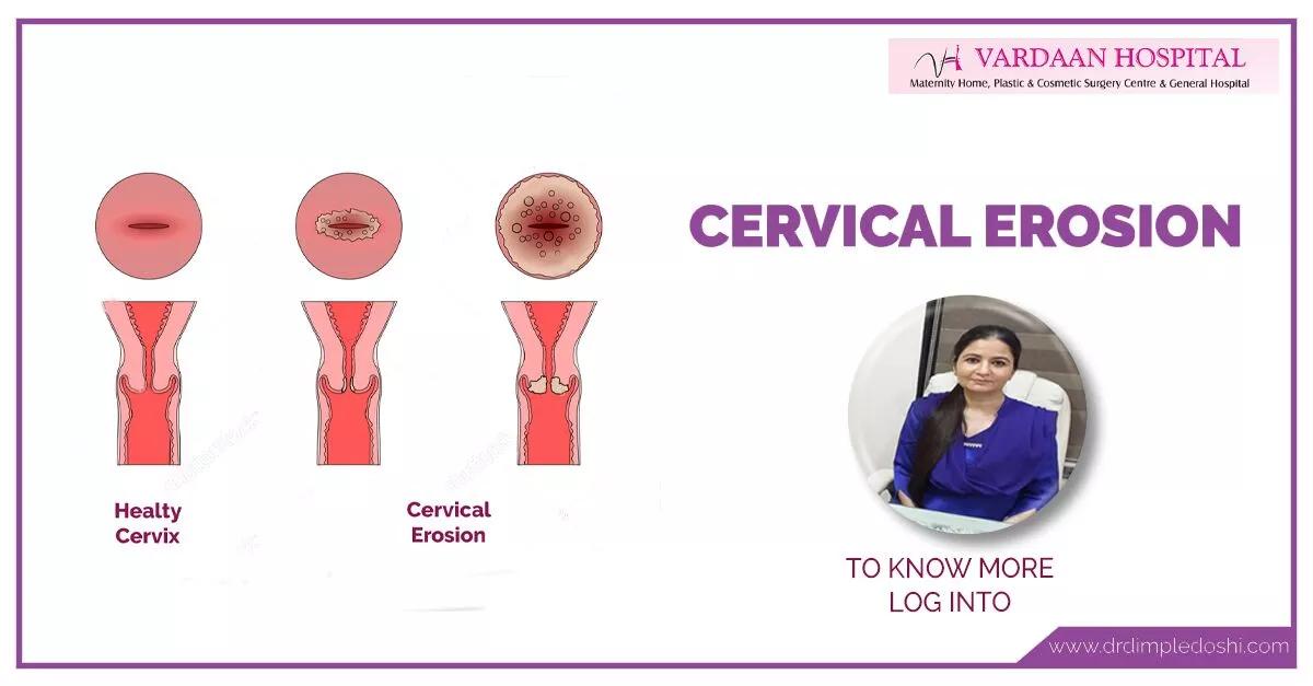 Cervical erosion is one of the most commonly found gynecological conditions. Cervical erosion is prevalent amongst 17 to 50%young population; incidence could be as high as up to 80% in sexually active adolescents. The prevalence decreases with age 35 and above. Cervical erosion happens when cells from inside the cervical canal grow onto the outside of the cervix. These cells are called glandular cells. Glandular cells are red, so the area looks red. Cervical Erosion