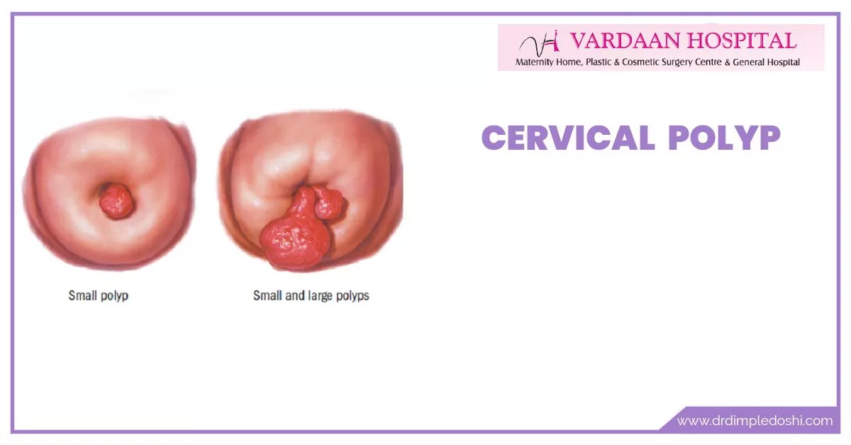 Cervical polyps