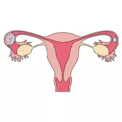 ECTOPIC-PREGNANCY