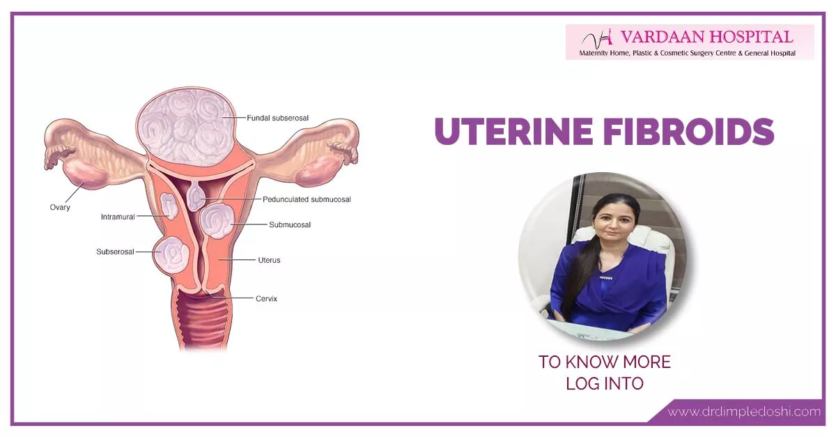 Uterine-Fibroids