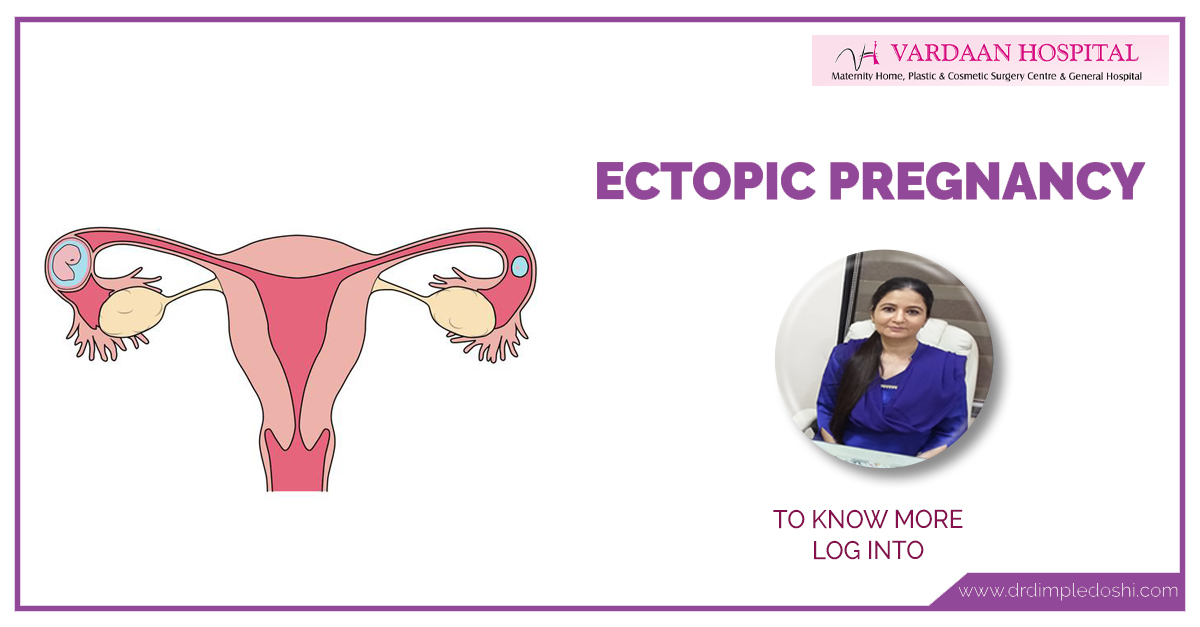Ectopic-Pregnancy