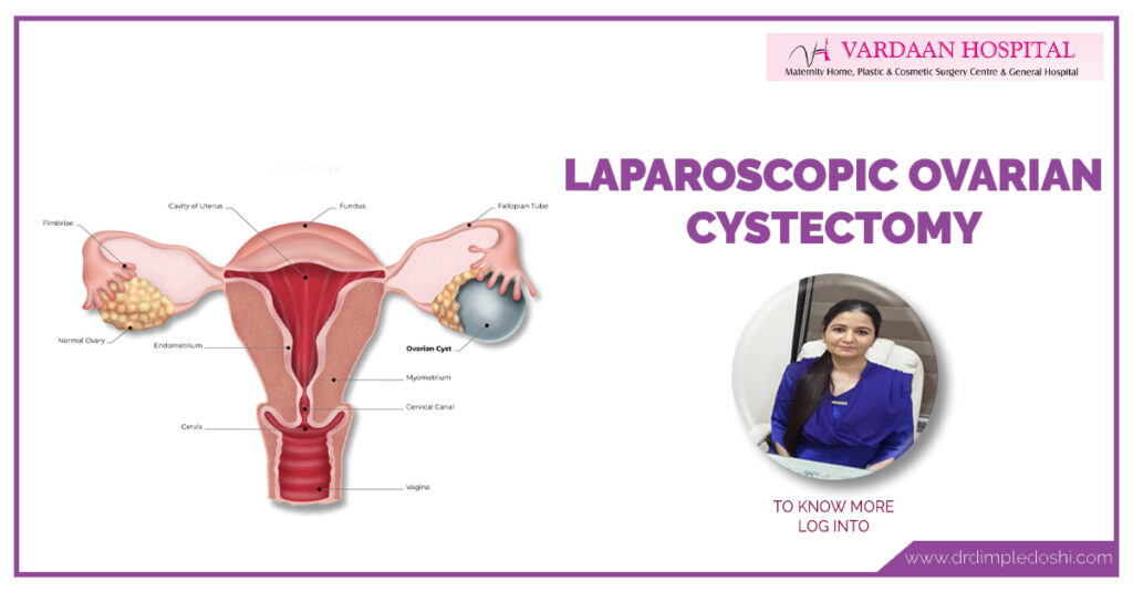 Laparoscopic Ovarian Cystectomy Treatment Risks Cost