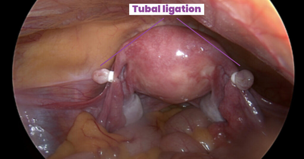 Tubal-ligation-suregery