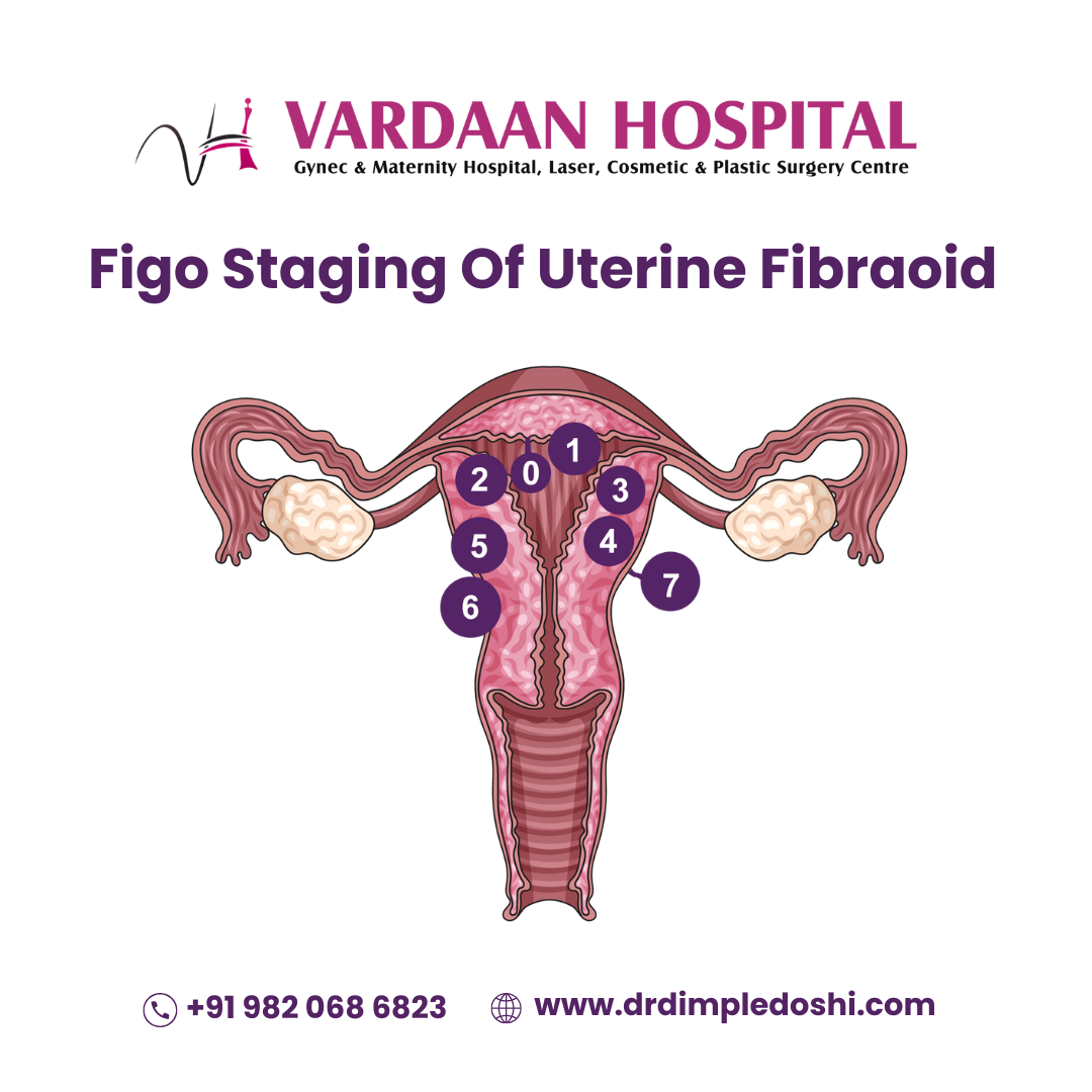 Figo Staging of uterine fibroid