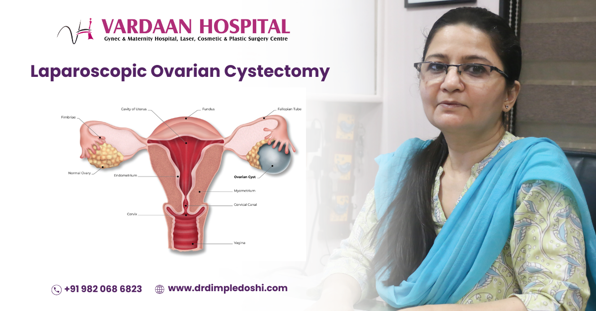 Laparoscopic Ovarian Cystectomy