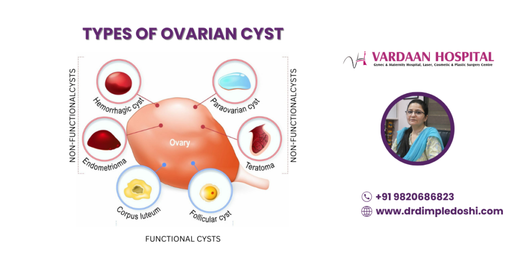 types of ovarian cyst