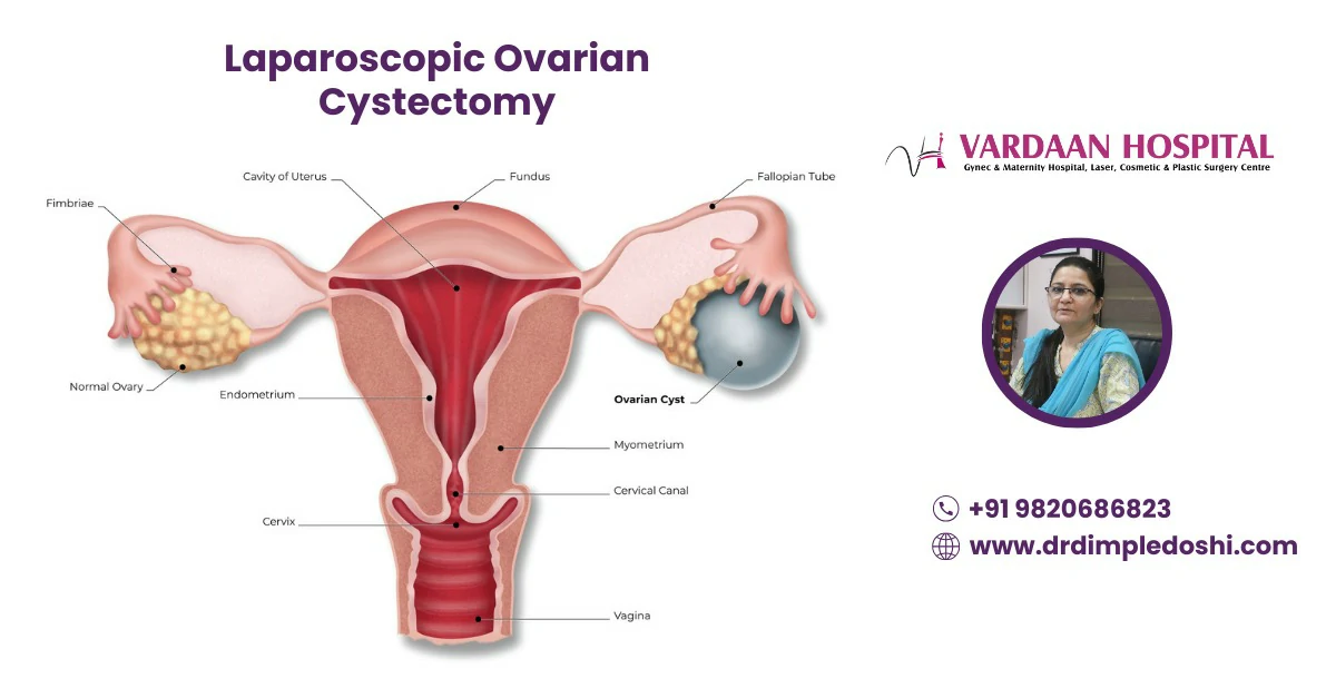 Laparoscopic Ovarian Cystectomy Banner images