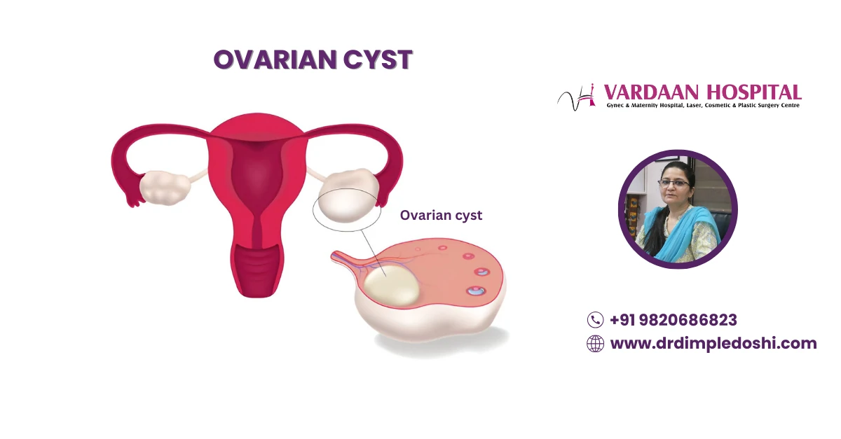 Ovarian Cyst Banner