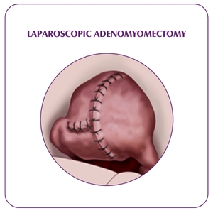 ADENOMYOMECTOMY SURGERY​