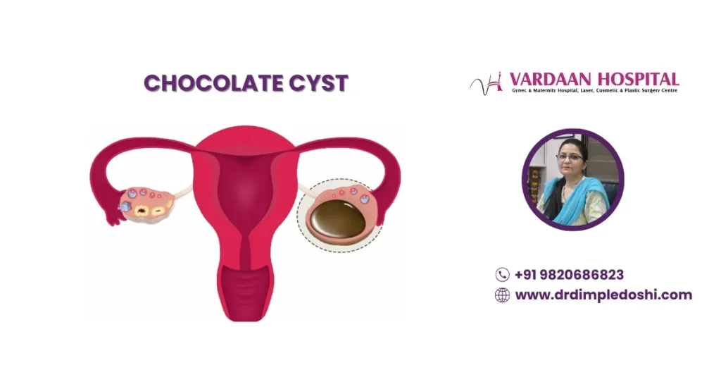 Chocolate Cyst Treatment