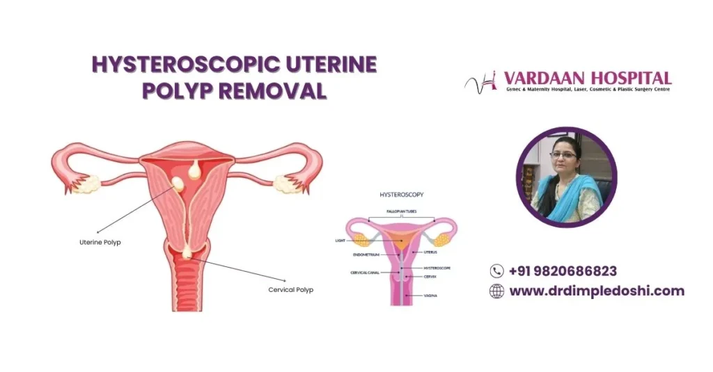 Hysteroscopic Uterine Polyp Removal