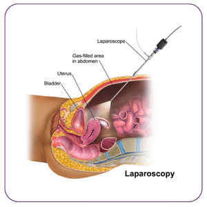 LAPAROSCOPIC HYSTERECTOMY​