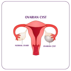 LAPAROSCOPIC OVARIAN CYST SURGERY