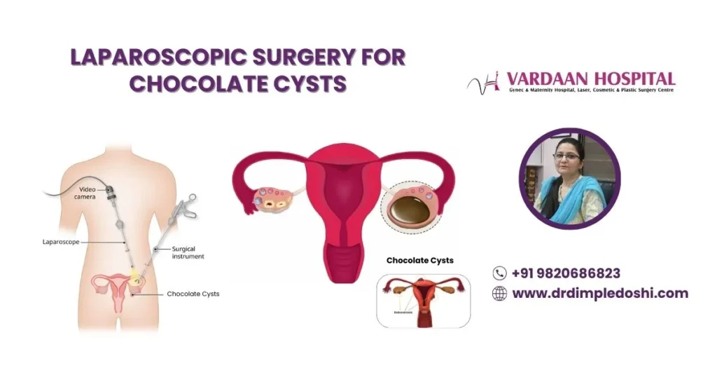 Laparoscopic Surgery for Chocolate Cysts