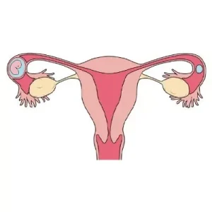 ECTOPIC-PREGNANCY