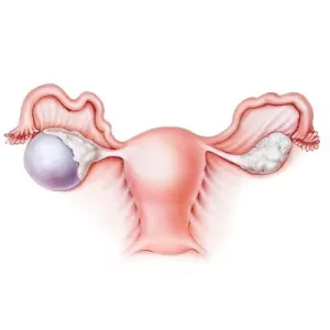 OVARIAN-CYST.webp